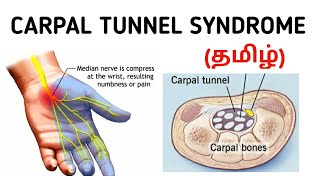 Carpal Tunnel Syndrome  Causes  Symptoms  Investigation  Treatment  தமிழ் [upl. by Eleonora]