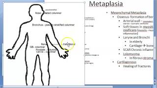 Pathology 038 a Metaplasia types Cell adaptation atrophy hypertrophy hyperplasia squamous columnar [upl. by Nelram20]