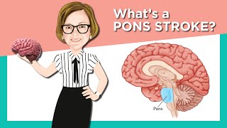 Pons Stroke [upl. by Landon]