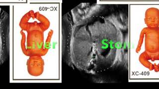 TMT Fetal Cardiac Evaluation  Part I by Dr Alpana Joshi [upl. by Gati]