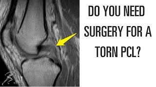 Do you need surgery for a torn PCL [upl. by Nyladnek]