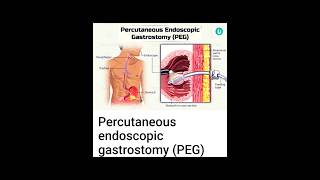 Percutaneous Endoscopic Gastrostomy PEG [upl. by Hastie320]