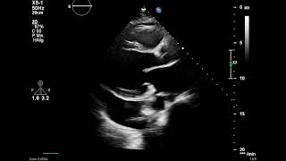 Pericardial effusion echocardiography TTE [upl. by Viking]