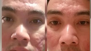 Deep acne scar before and after using Dermapen [upl. by Shannen]