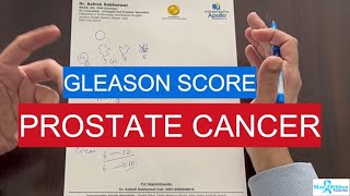 Gleason Score Prostate Cancer  What is Gleason 6  7 8 9 10 [upl. by Arayc]