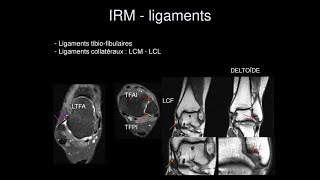 Rappel anatomique ligamentaire de la cheville [upl. by Sirak10]