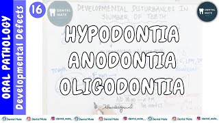 Hypodontia  Anodontia  Oligodontia  Developmental disturbances of teeth  Dr Paridhi Agrawal [upl. by Ahcsas67]