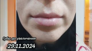 Увеличила губы 😱 выровняла осиметрию губ revolax 1ml [upl. by Aelem]