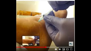 Video  sinus tarsi injection [upl. by Vokaay]