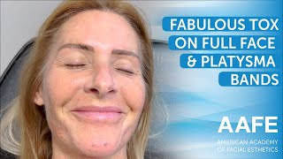 Fabulous Tox on Full Face amp Platysma Bands [upl. by Athenian]