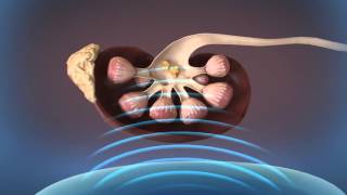 Shockwave Lithotripsy SWL [upl. by Festa]