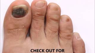 Is Toenail Fungus Black Know More about Toenail Fungus [upl. by Bettina]