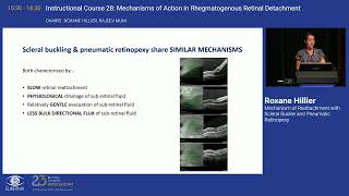 Mechanism of Reattachment with Scleral Buckle and Pneumatic Retinopexy [upl. by Aliuqat]