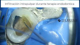 Anestesia intrapulpar durante terapia endodontica [upl. by Files]