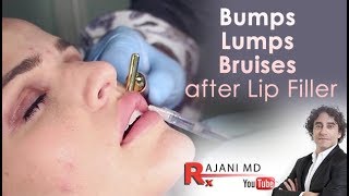 Bumps Lumps Swelling and Bruising after lip FillersDr Rajani [upl. by Navlys494]