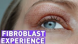 FIBROBLAST treatment experiencebefore and after 7 days [upl. by Keryt]