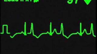 Ventricular Bigeminy  ECG Simulator  Arrhythmia Simulator [upl. by Anitsirt]