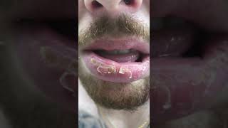 Exfoliative Cheilitis  My Lips Back in January 2020 [upl. by Yttam304]