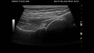 Ultrasoundguided Glenohumeral Joint injection [upl. by Ennayk]