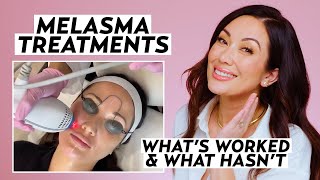 My Melasma Treatment Journey What Actually Worked to Treat Hyperpigmentation  Skincare Susan Yara [upl. by Schnorr]