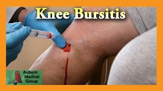 Pes Anserine Bursitis Knee Injection  Auburn Medical Group [upl. by Lauzon]