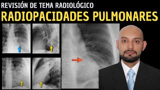 Revisión de Tema 88 Radiopacidades pulmonares [upl. by Milon748]