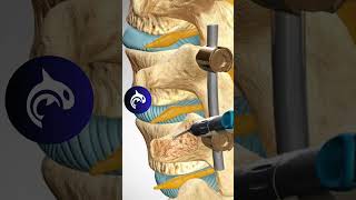 See how a Lumbar Fusion of the Spine works in 3D animation backpain stem spine [upl. by Dranel]