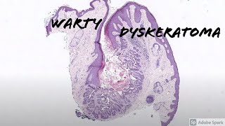 Warty Dyskeratoma 5Minute Pathology Pearls [upl. by Ardnassak873]