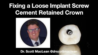 How to Fix Loose Implant Screw on a Cement Retained Crown [upl. by Annabel779]