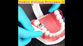 Cavity Filling Process 😱  Teeth Cavity Hole Filling Process5MinuteCraftsYouTube ProfessorOfHow [upl. by Agueda711]