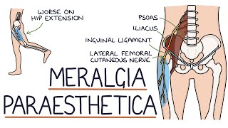 Understanding Meralgia Paraesthetica [upl. by Holcomb]