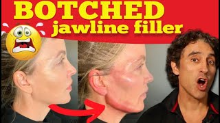 JAWLINE FILLER GONE WRONG  Botched Jawline Contouring [upl. by Drofla]