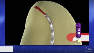 Future of Endodontics  The New Shaping Standard Advanced Endodontics [upl. by Naletak]