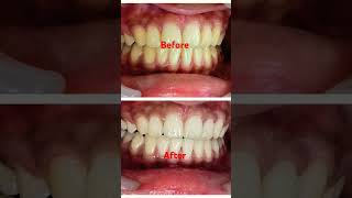 Bleaching of teeth [upl. by Gary]