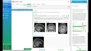 Step 2 Anterior Commissure  Posterior Comissure ACPC alignment [upl. by Callery453]