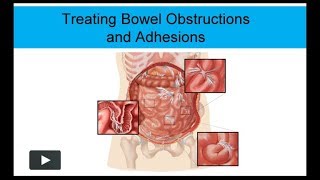 Treating Bowel Obstructions and Adhesions NonSurgically [upl. by Elay]