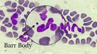 Barr Body in Neutrophils [upl. by Akedijn]