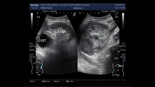 Adrenal Cysts and Myelolipomas [upl. by Adur]