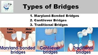 Types Of Dental Bridges [upl. by Unni]