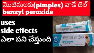 Benzoyl peroxide gel uses Telugupimplesacne treatment telugu [upl. by Atikkin]