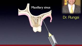 OBS4 InfraZygomatic Crest [upl. by Esenahs]