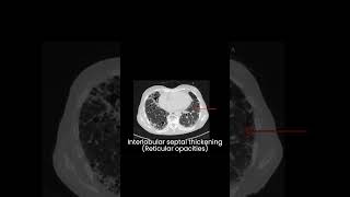 UIP Usual Interstitial pneumonia Idiopathic pulmonary fibrosis l Interstitial lung disease l HRCT [upl. by Tinaret]