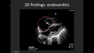 Basic Valve Evaluation with POCUS [upl. by Rayham]