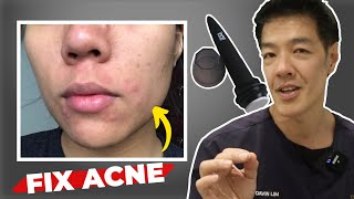 How to get rid of Acne Scars  Dr Davin Lim [upl. by Namie]