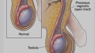 हाइडोसील मे पानी जामा होना या अंडकोश में तरल भर जाना टरमा or Hematocele या mild infection Tv cancer [upl. by Grani]