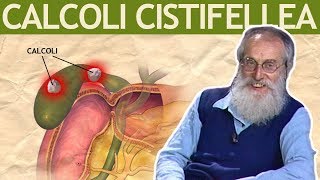 Dott Mozzi Calcoli alla cistifellea biliari colecisti [upl. by Bergwall587]