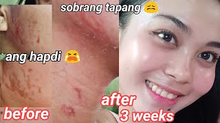 How I cleared my skin PRESTIGE REJUVENATING SET REVIEW GLASS SKIN ANG PEG 😱 [upl. by Marpet]