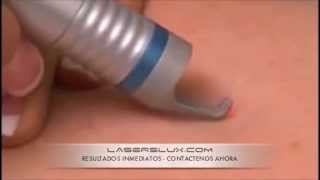 Equipos Laser  LasersLux  Telangiectasias [upl. by Ahsinrad]