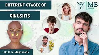 Stages of Sinusitis and how it progresses  Dr K R Meghanadh Medyblog [upl. by Harehs]