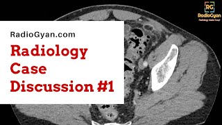 Acute Epiploic Appendagitis  Radiology Board Review Case [upl. by Ecyaj227]